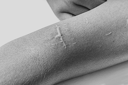 Корекція рубців