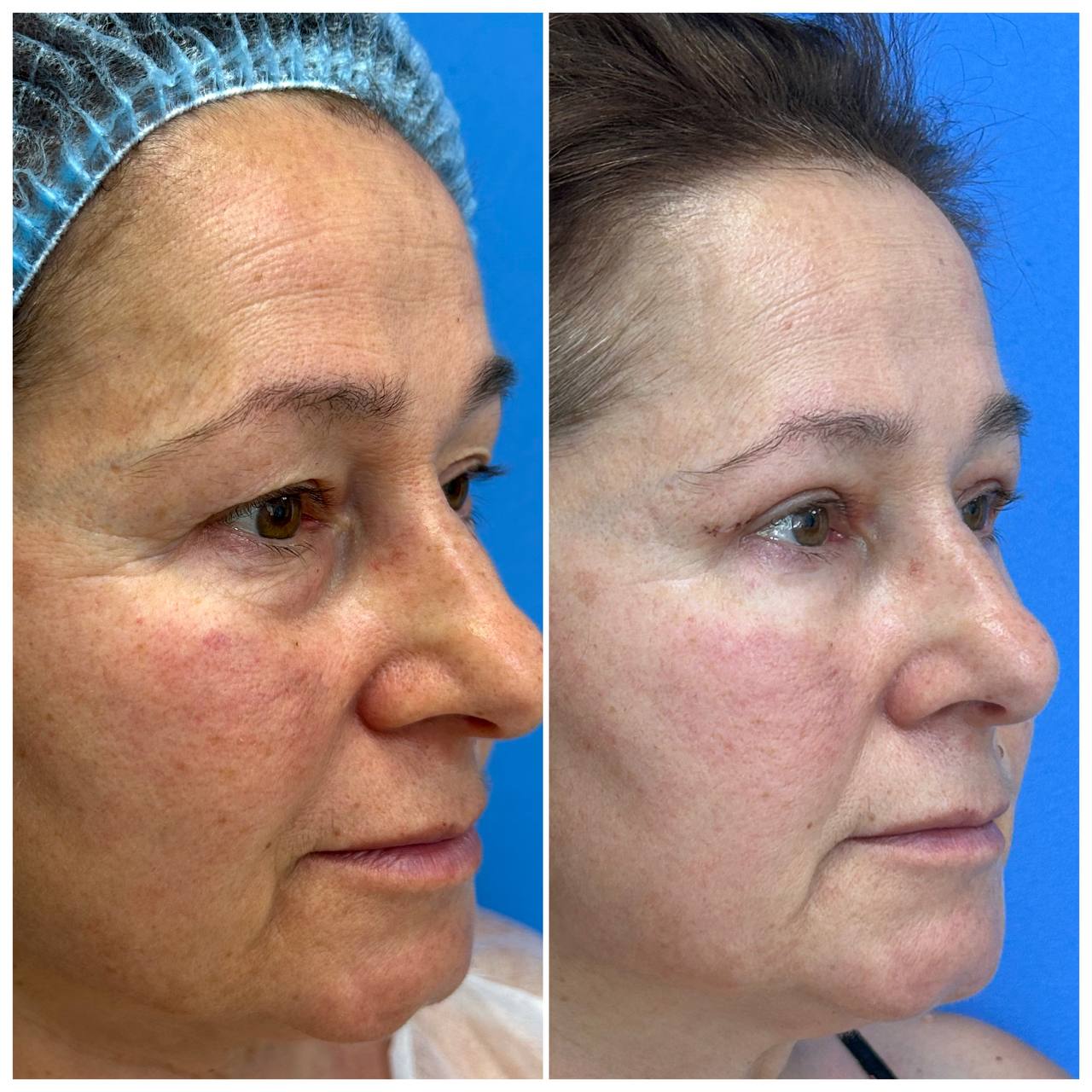 Блефаропластика