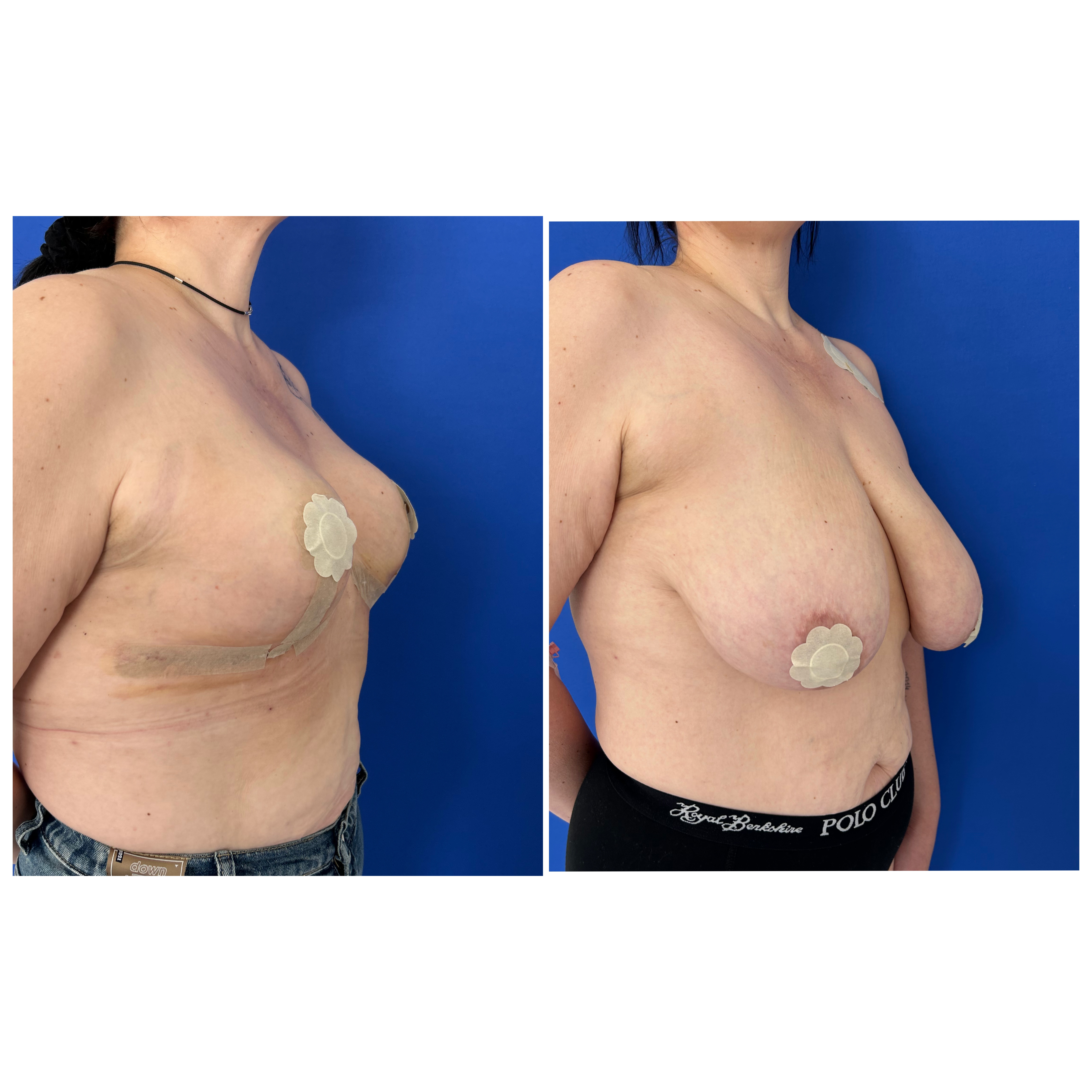 Мамопластика