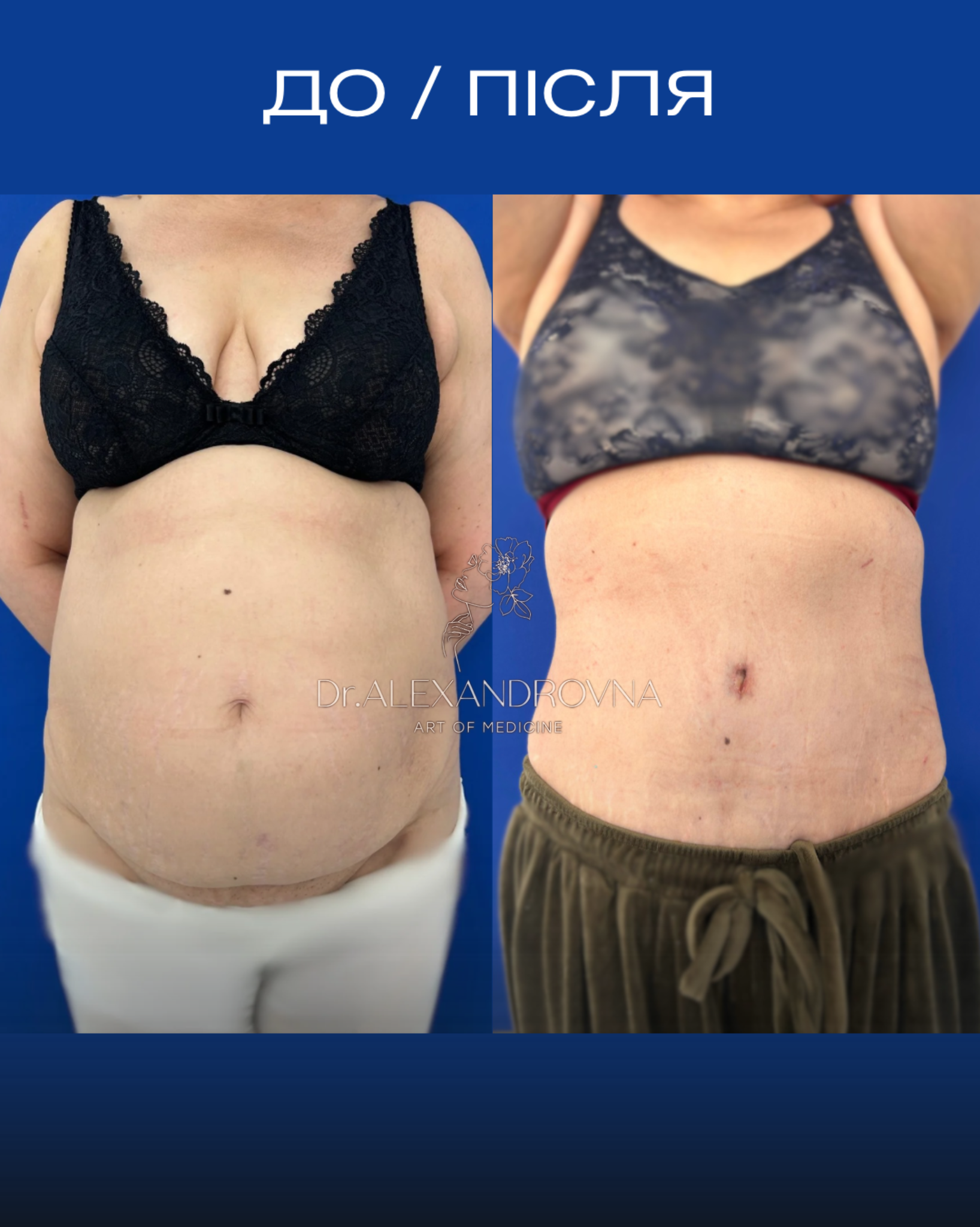 Отопластика