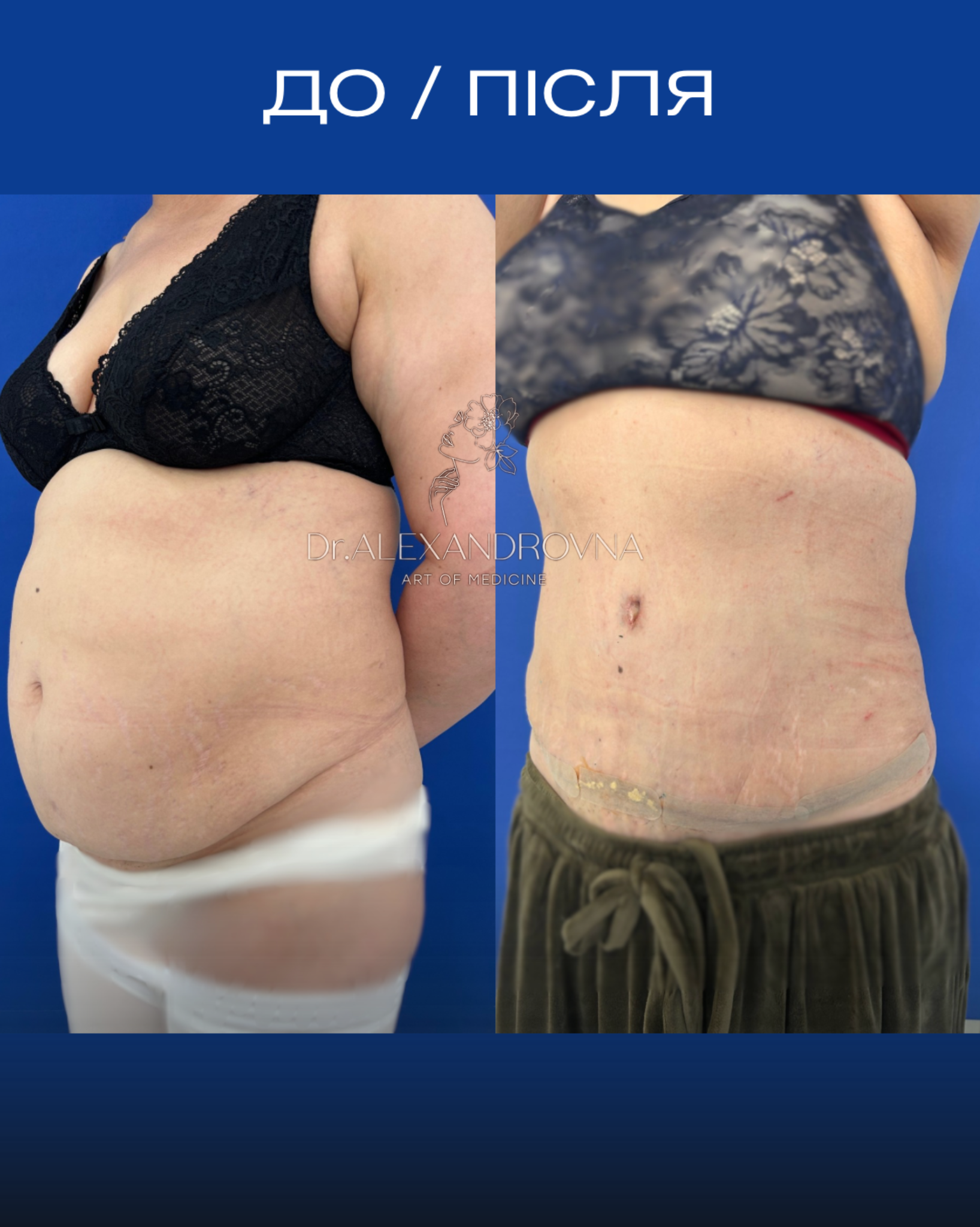 Отопластика