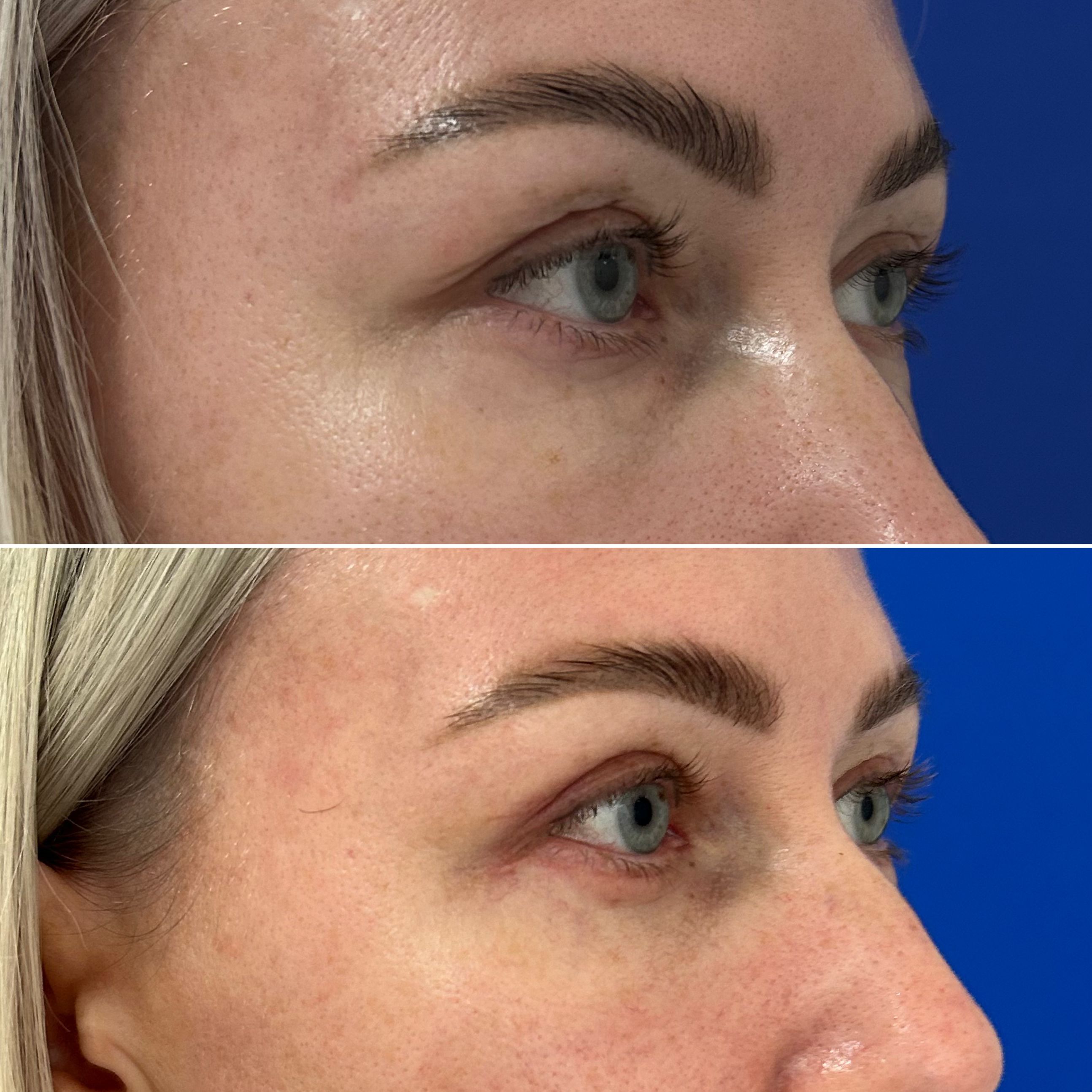 Отопластика