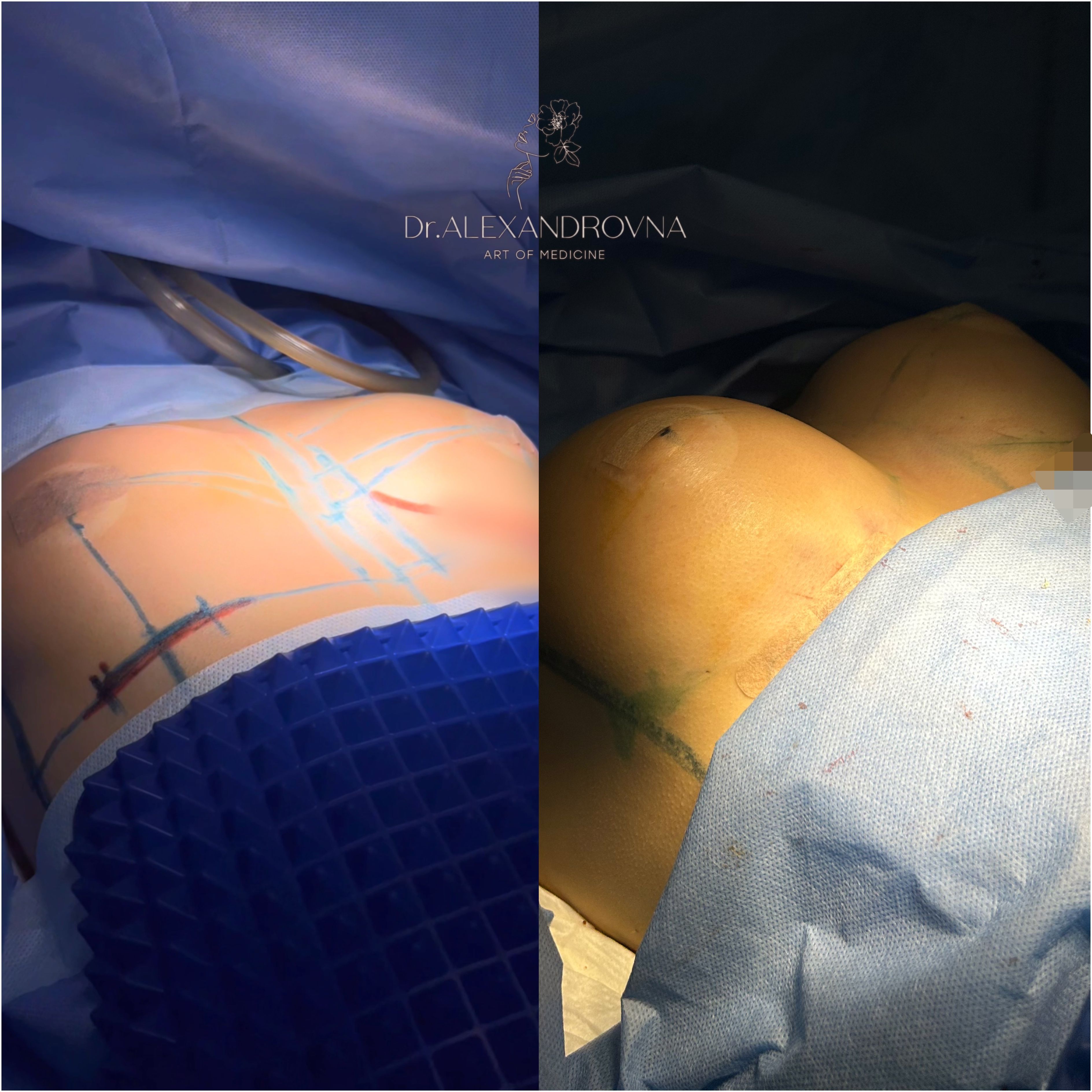 Отопластика