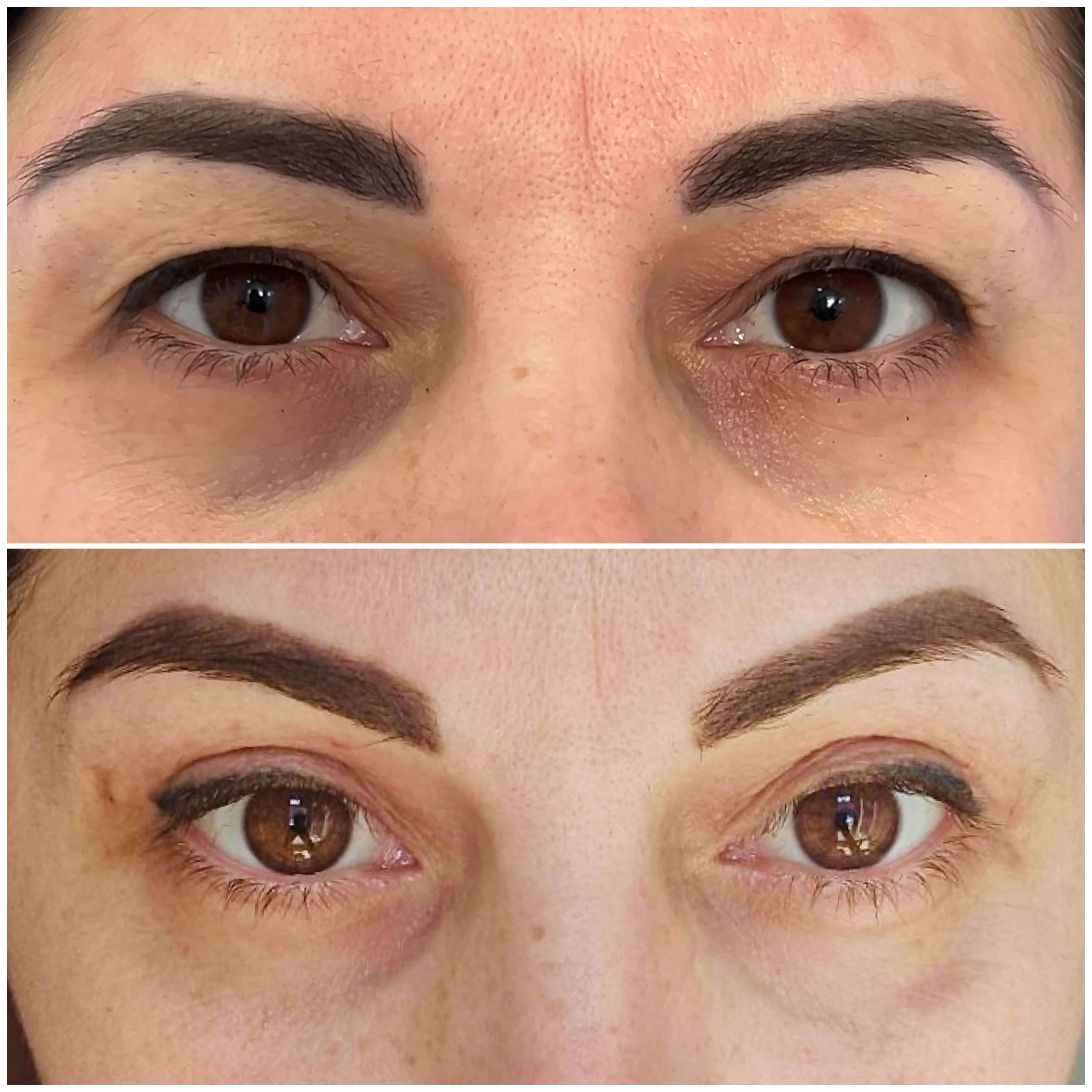 Верхня блефаропластика