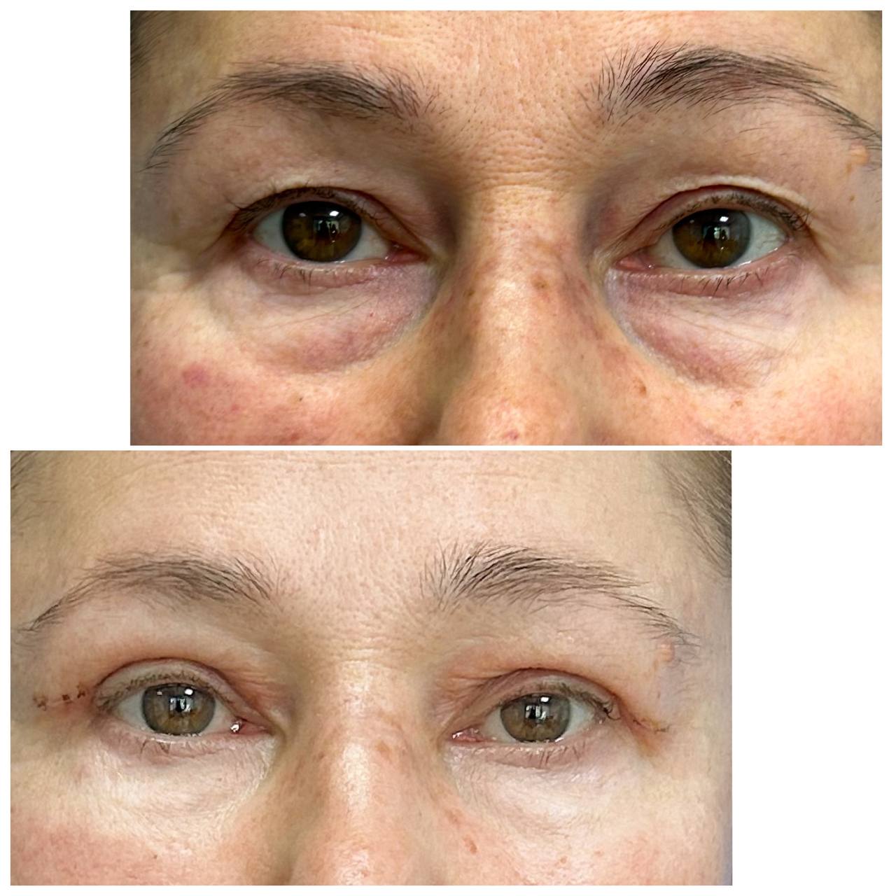 Блефаропластика