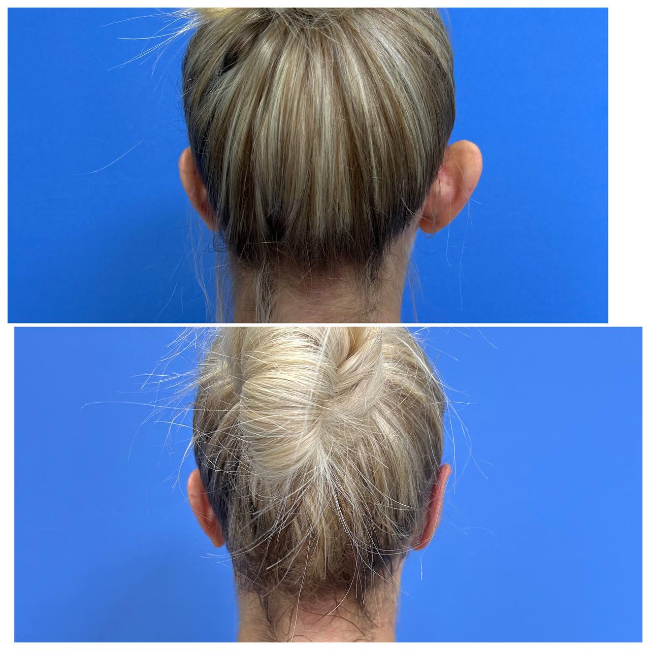 Отопластика