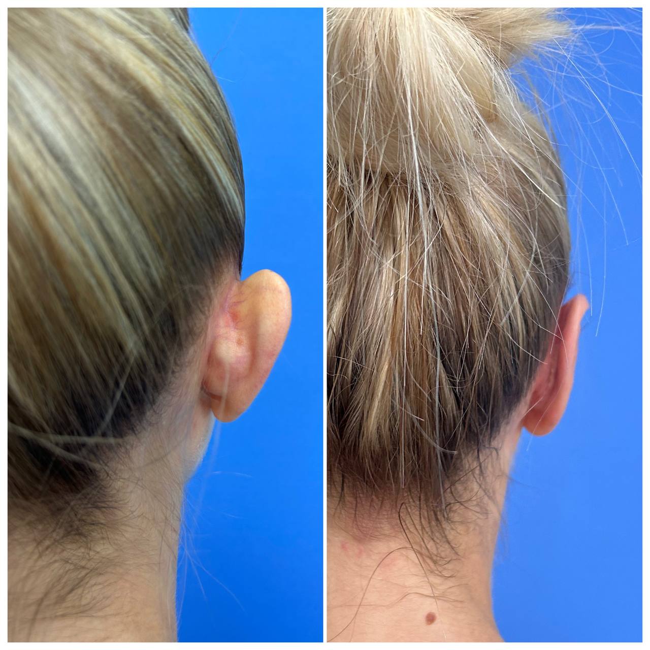 Отопластика