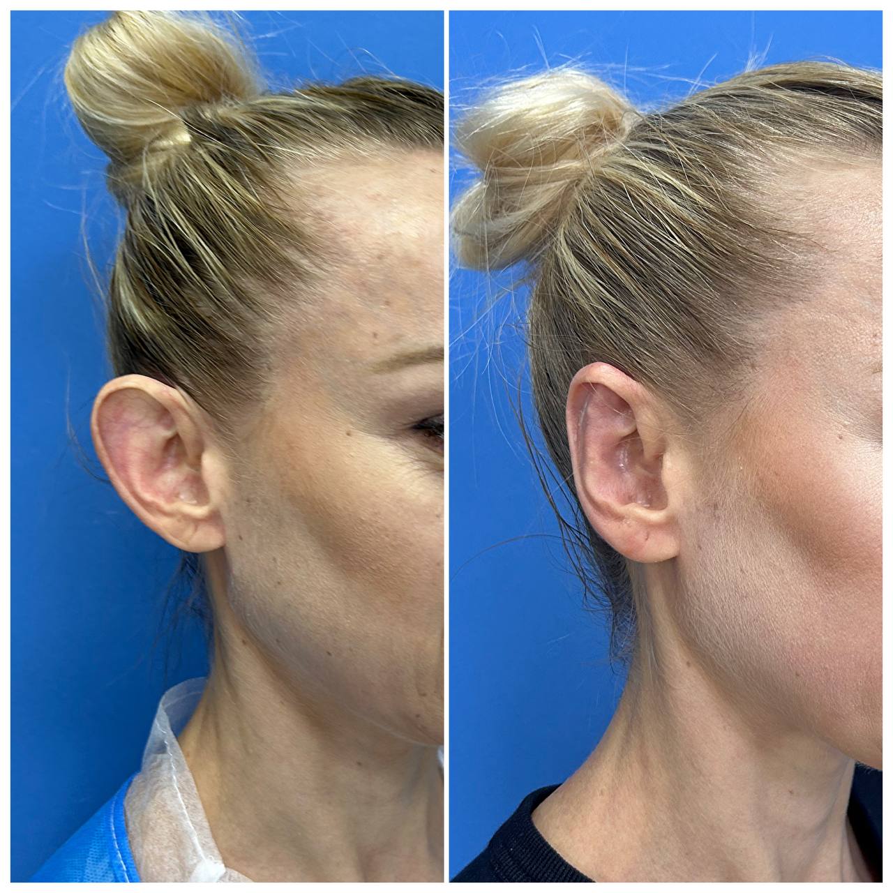 Отопластика