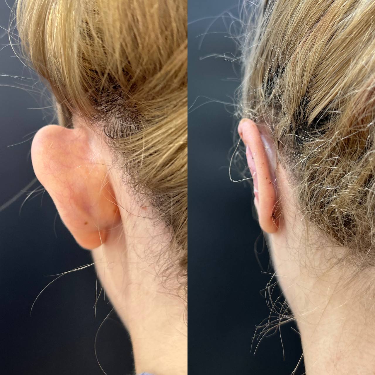 Отопластика