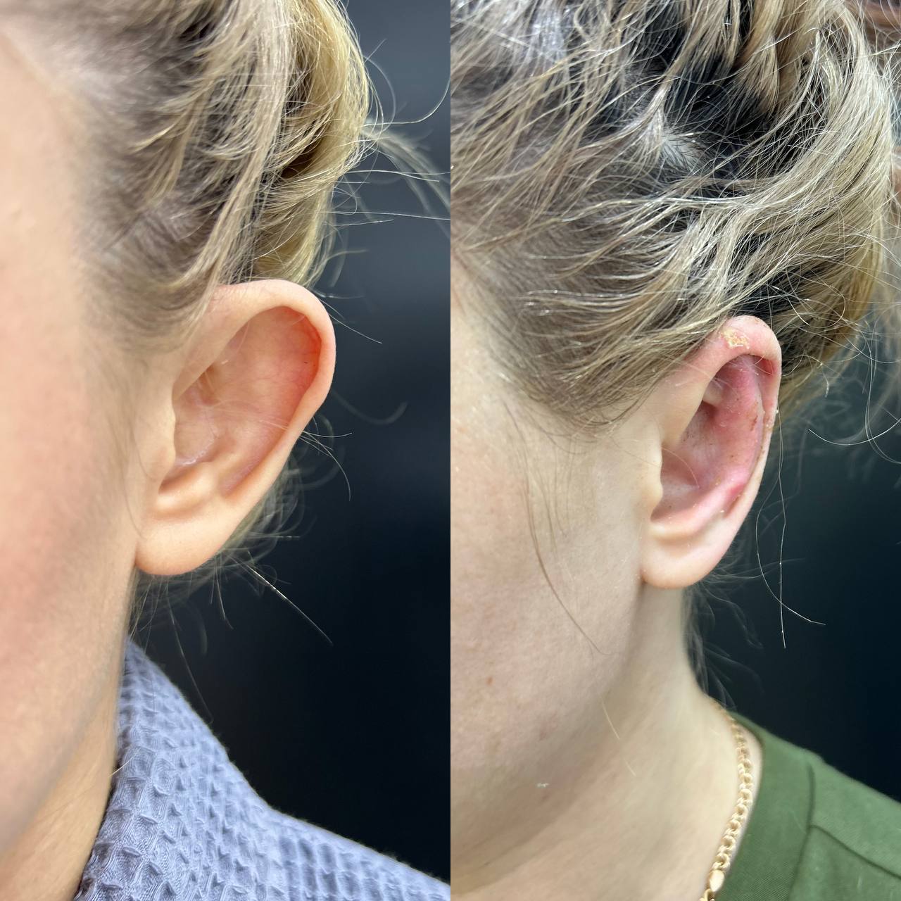 Отопластика