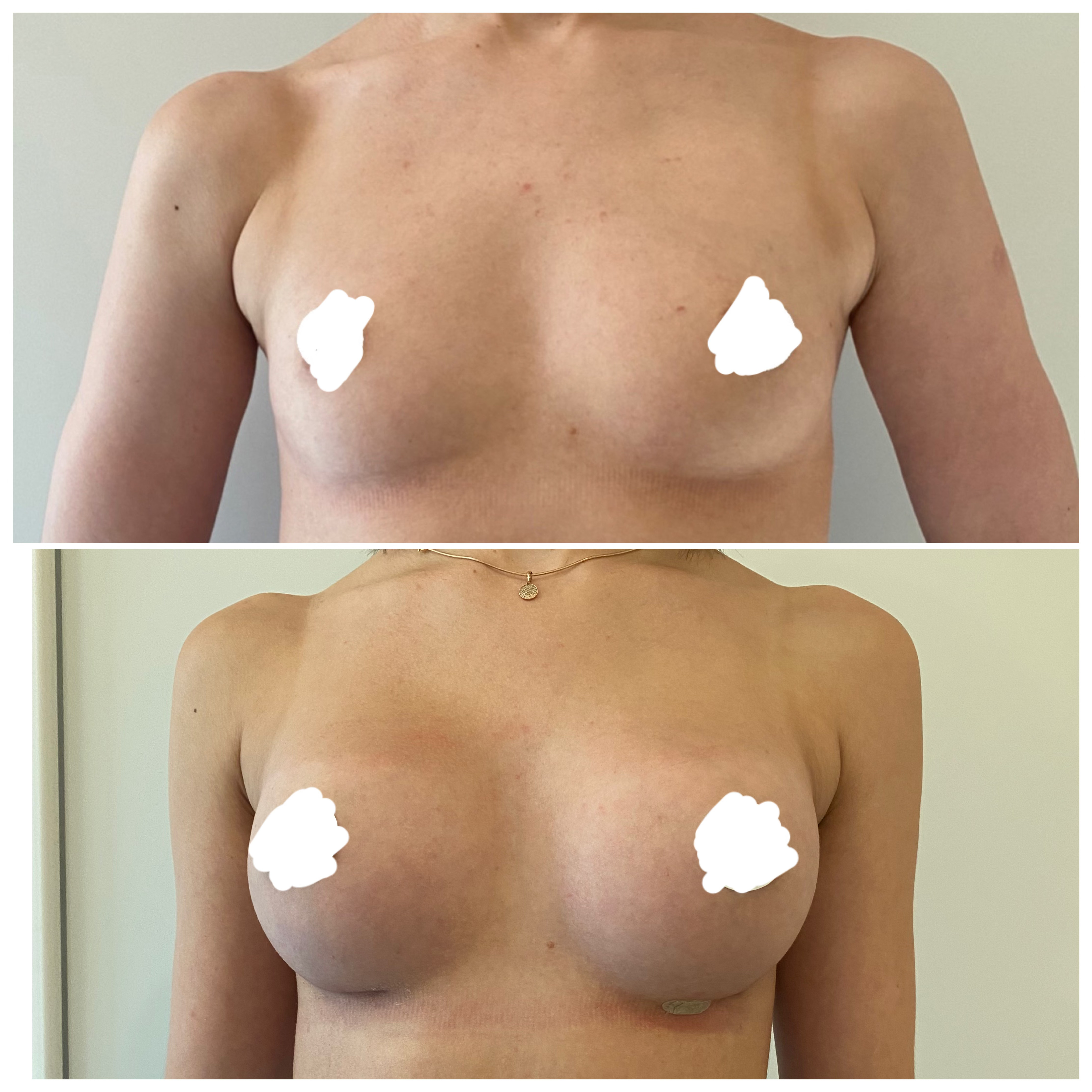 Мамопластика