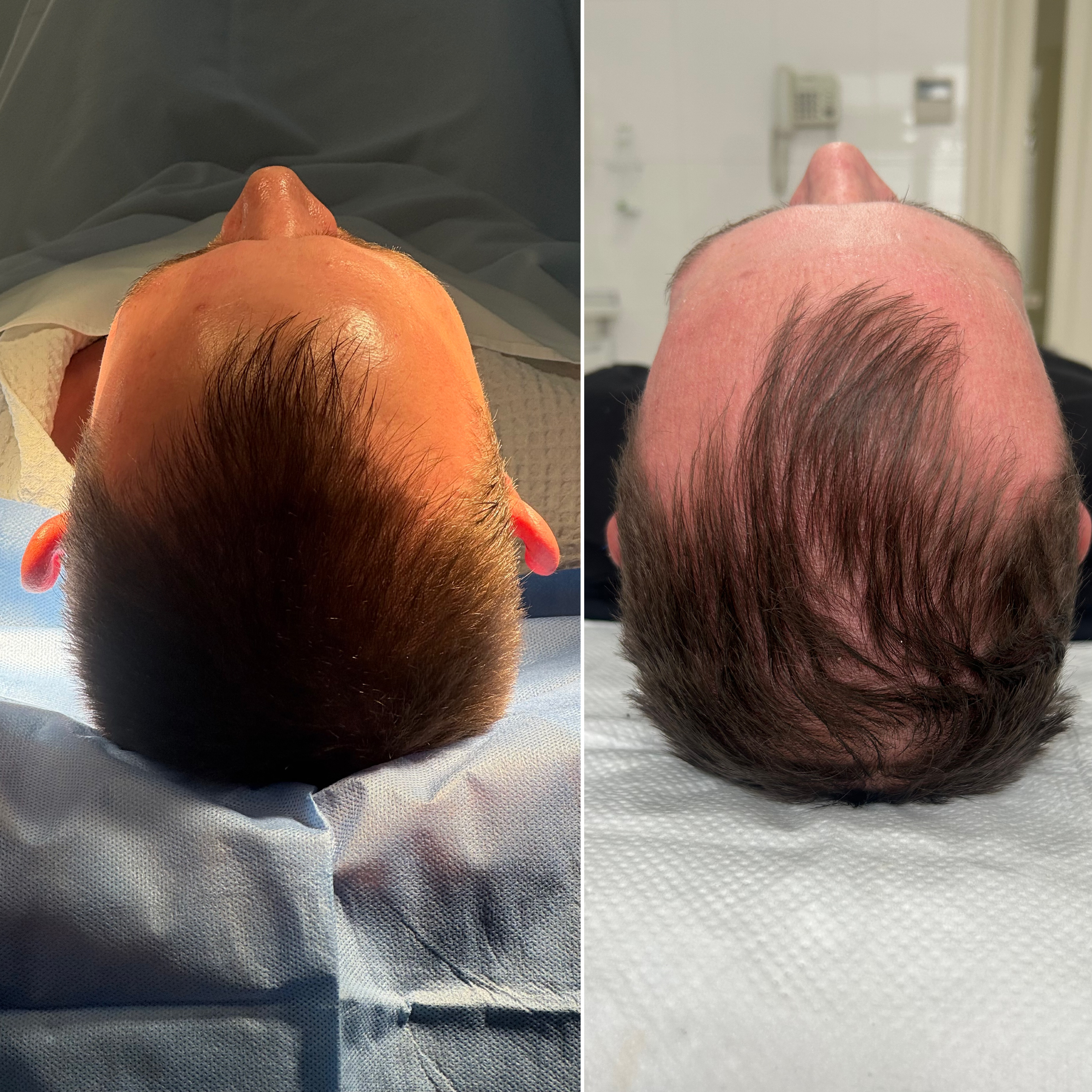 Отопластика