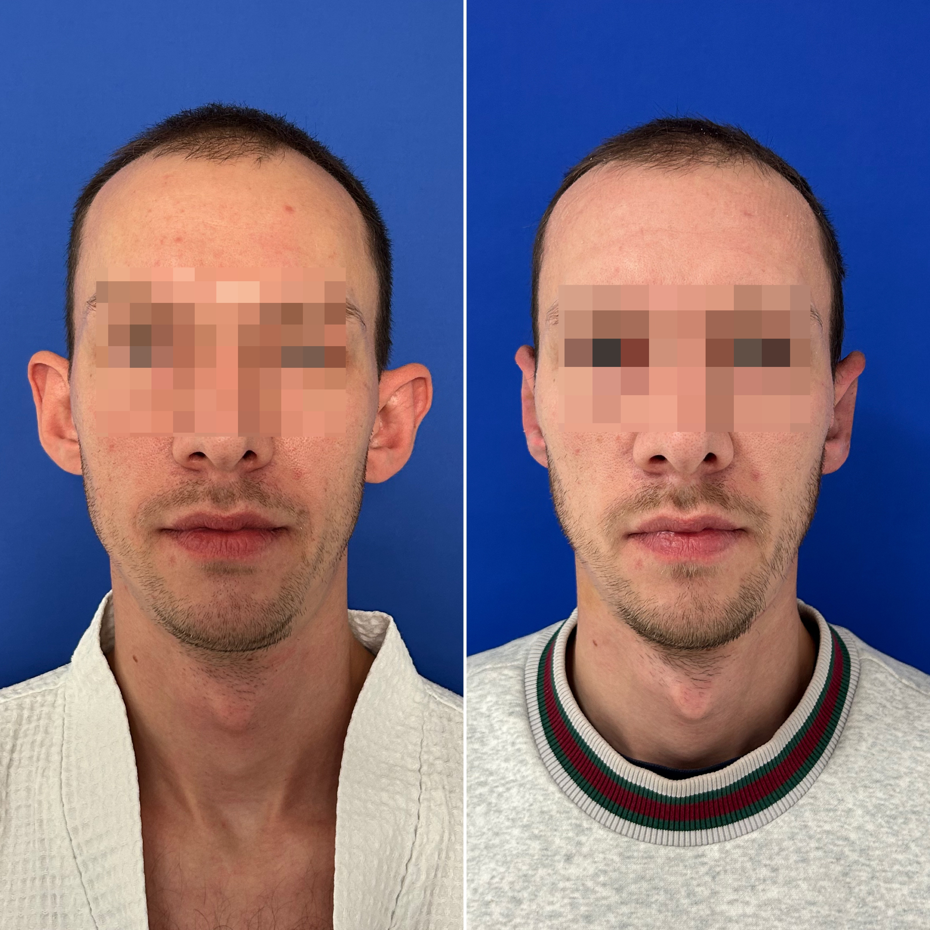 Отопластика